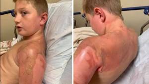 Den 11-årige dreng vågnede med nogle frygtelige forbrændinger, efter at hans kam